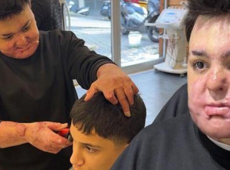 15 Yaşındaki Çocuk, Yangın Faciasında Hayatını Değiştiren Savaşını Anlatıyor