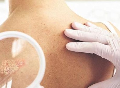 Zenginlerin Sırrı: Sedef Hastalığı Neden Artıyor?