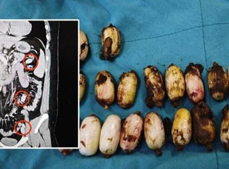 Eskişehir’de Şok Olay: 44 Kaps&uuml;l Bonzai Midesinde Yakalandı!