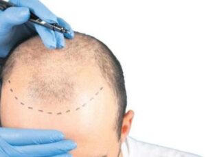 Sa&ccedil; Ekimi Sekt&ouml;r&uuml;nde Şok Vergi İhlalleri: 1 Milyar TL’yi Aşan Farklar Tespit Edildi!