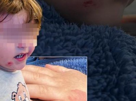 Kreş İddiaları Şoke Etti: 2,5 Yaşındaki &Ccedil;ocuğa Darp!