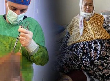 Yıllarca S&uuml;ren Suskunluk: Kadın Karnından &Ccedil;ıkan 40 Kilogramlık Kitleyle Şaşırttı!