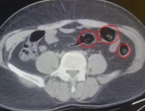 Yolcu Otob&uuml;s&uuml;nde Uyuşturucu Şokunu Yaşatan R&ouml;ntgen Taraması: 502 Gram Metamfetamin