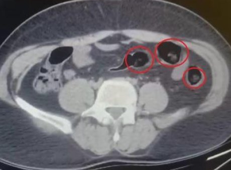 Yolcu Otob&uuml;s&uuml;nde Uyuşturucu Şokunu Yaşatan R&ouml;ntgen Taraması: 502 Gram Metamfetamin