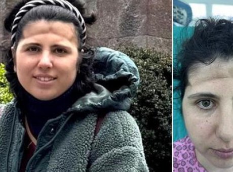 Beyin T&uuml;m&ouml;r&uuml; Ameliyatı Sonrası Estetik &Ccedil;&ouml;k&uuml;nt&uuml;ye &Ccedil;&ouml;z&uuml;m Bulundu!