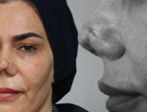 Hayatı Kabusa D&ouml;nen Kadının Dramı: 4 Ameliyat Sonrası Y&uuml;zdeki Değişim