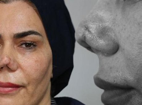 Hayatı Kabusa D&ouml;nen Kadının Dramı: 4 Ameliyat Sonrası Y&uuml;zdeki Değişim