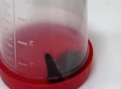 Siirt’te Şok Edici Sağlık Olayı: 6 Yaşındaki &Ccedil;ocuğun Boğazından S&uuml;l&uuml;k &Ccedil;ıktı!